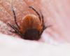 Tick-borne disease can cause arthritis